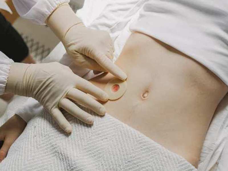 urostoma